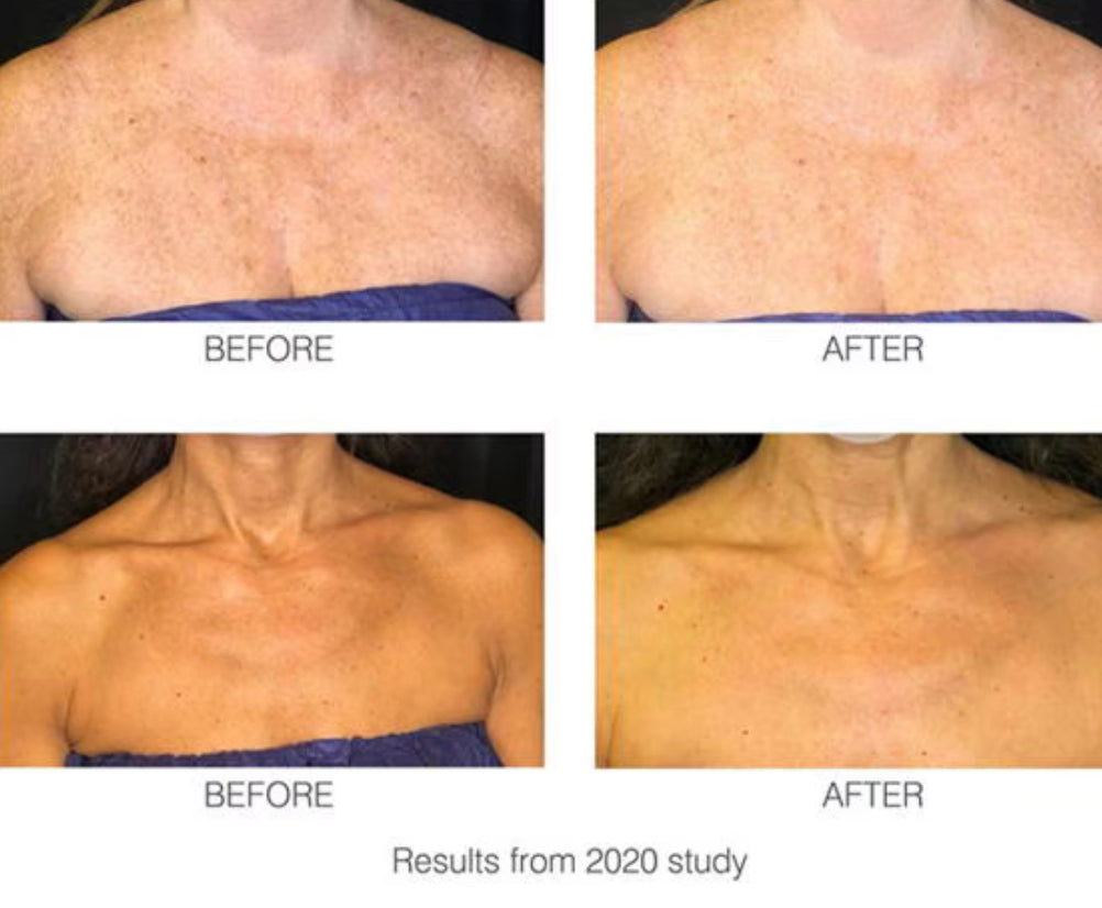 Rio DecoLITE LED Beauty Treatment Mask – Clinically Proven Light Therapy for Radiant Skin